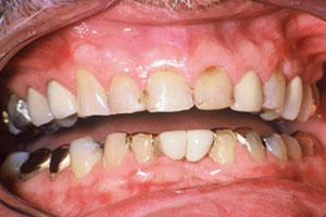 Full Mouth Reconstruction – Before