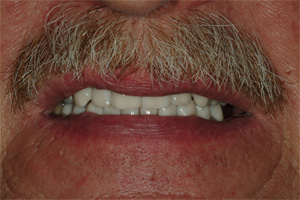 Full Mouth Reconstruction - After