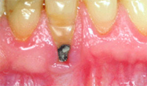 Example of Root Caries
